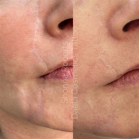 Scar Camouflage Tattoo Training How It Works Benefits Amp More Daela Scar Camouflage Tattoo Training How It Works Benefits Amp More Daela