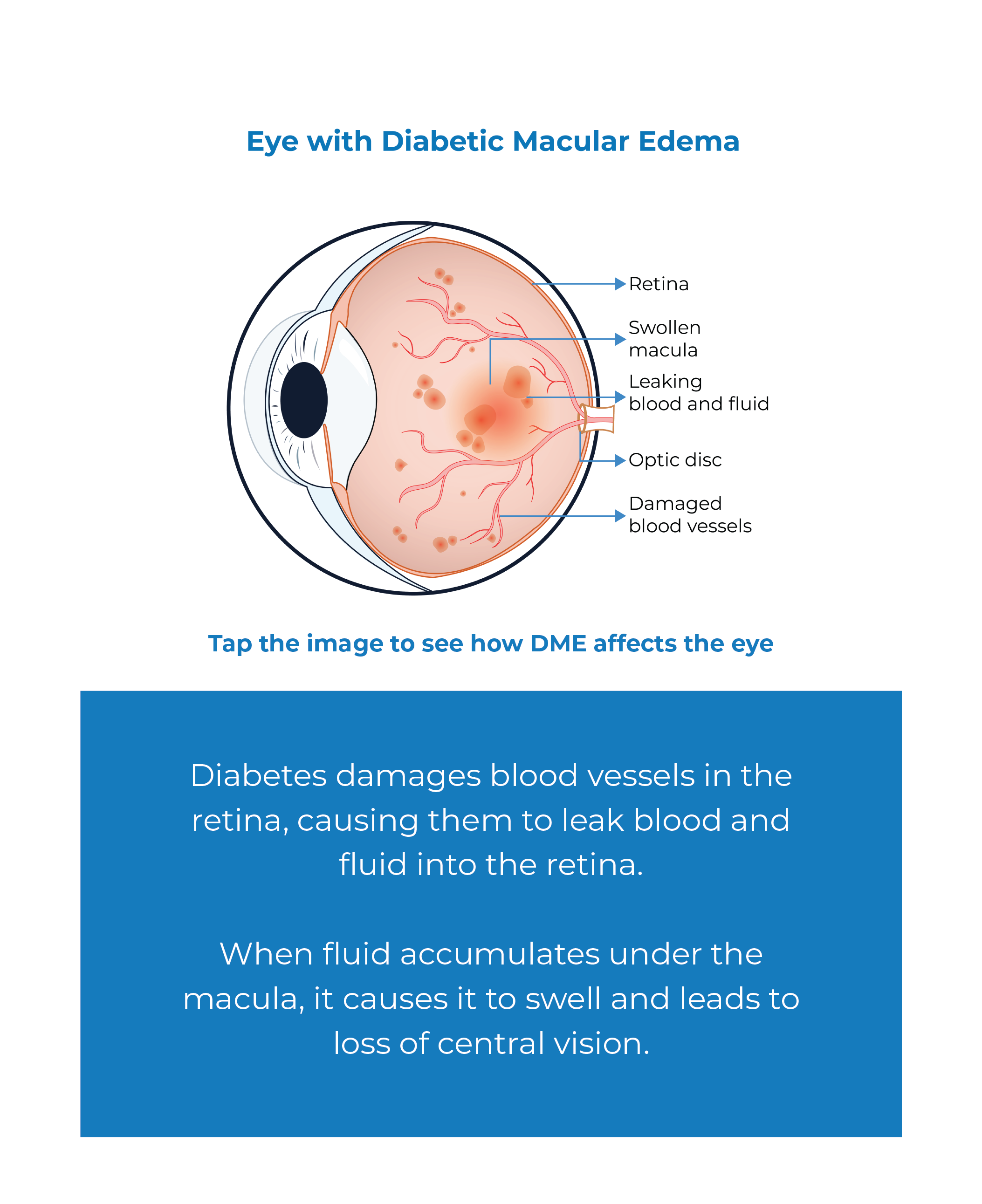 Schematic Diagram Of Dme Disease Download Scientific Diagram