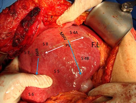 Segmental Oriented Liver Surgery Intechopen