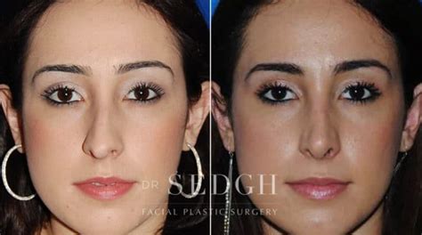 Septoplasty Photo Before And After 2 Rhinoplasty Cost Pics