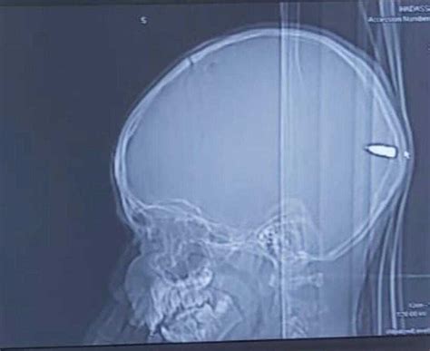 Shocked Doctors Find Bullet Lodged In Brain Of Sleepy 9 Year Old