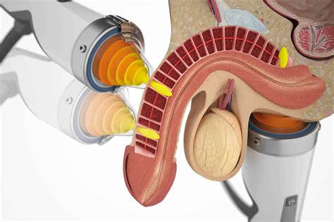 Shockwave Therapy For Ed