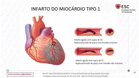 Sintomas Do Infarto Agudo Do Mioc Rdio Sintomas Do Infarto Agudo Do Mioc Rdio
