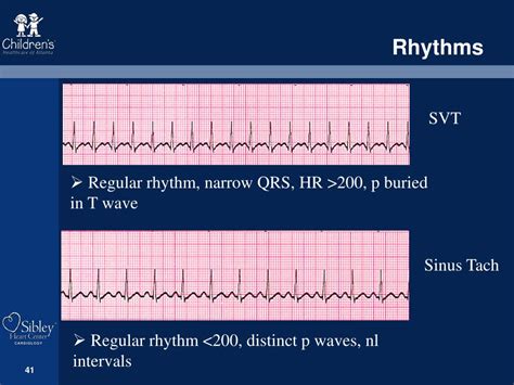 Sinus Tachycardia Vs Svt