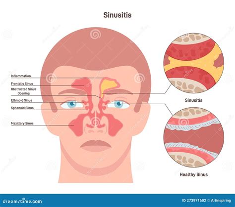Sinusitis Inflamed Sinus With Excess Mucus And Obstructed Airways