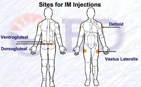 Sites For Intramuscular Im Injection Vascular Access Pinterest Sites For Intramuscular Im Injection Vascular Access Pinterest