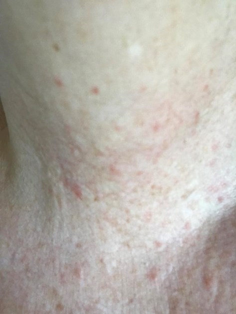 Skin Rash On Neck Thyroid