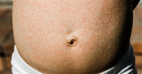 Skin Rash On The Stomach