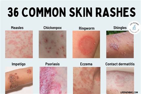 Skin Rashes On Stomach Skin Rashes On Stomach