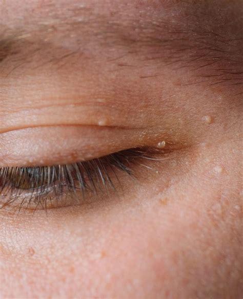 Skin Tags Around Eyes