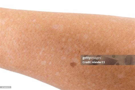 Small White Spots On Arms Liver Spots On The Skin Of An Old Person