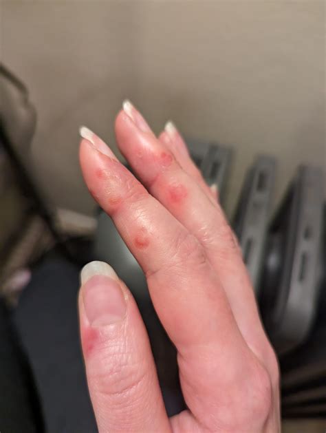 Sores On Fingers Not Itchy But Painful It S Been Weeks R Dermatology Sores On Fingers Not Itchy But Painful It S Been Weeks R Dermatology
