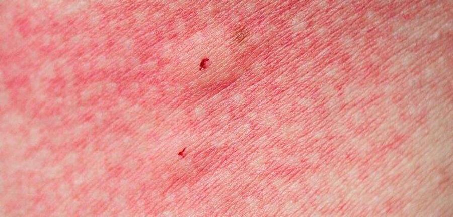 Spider Bite Vs Mosquito Bite