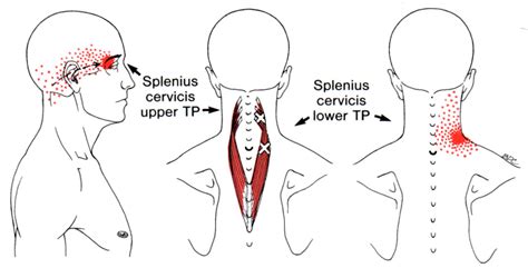 Splenius Capitis Trigger Points