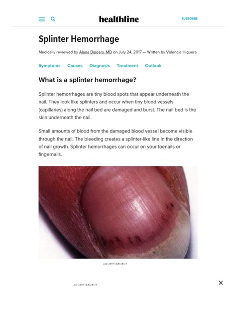 Splinter Hemorrhages Symptoms Causes And Treatments