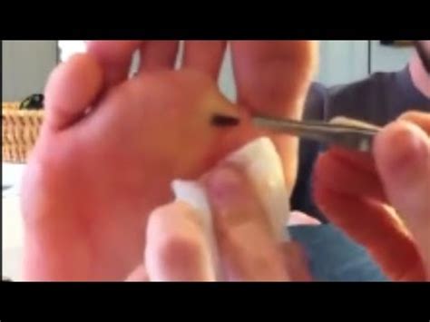 Splinter Removal His Foot Splinter Youtube