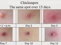 Stages Of Chickenpox