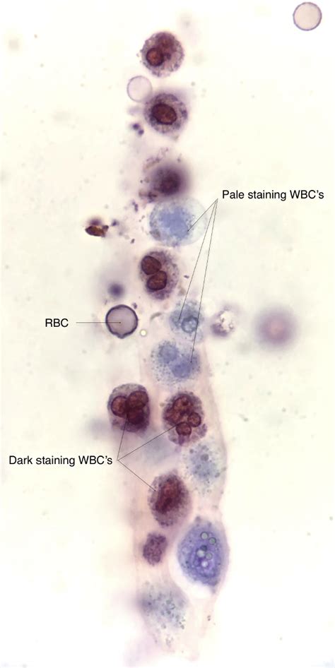 Stain Precipitate In Urine Stain Precipitate In Urine