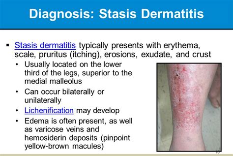 Stasis Dermatitis Eczema On Legs Causes Treatment
