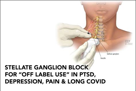 Stellate Ganglion Block Amp Ptsd Albany Clinic Carbondale Il
