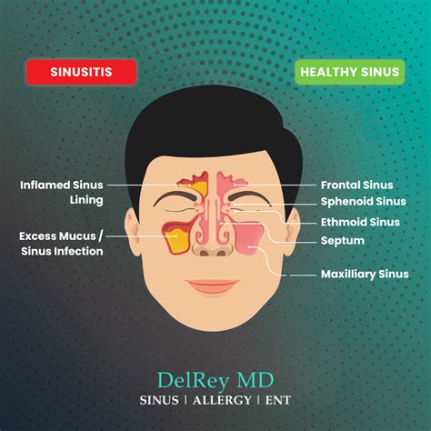 Stop Sinusitis Marina Del Rey Sinusitis Treatment Los Angeles Stop Sinusitis Marina Del Rey Sinusitis Treatment Los Angeles