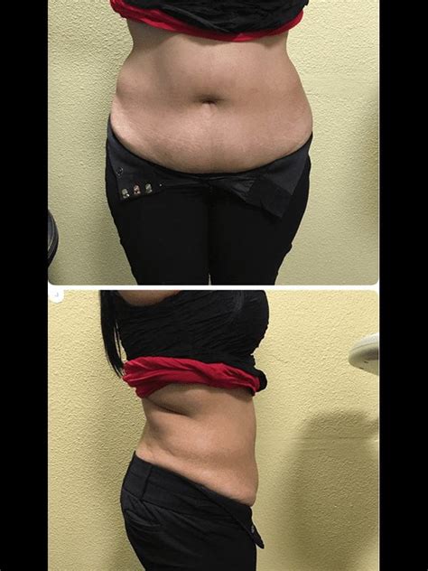 Strawberry Laser Lipo Tri Valley Medical Weight Control