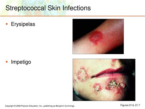 Streptococcal Infections As Related To Impetigo Pictures