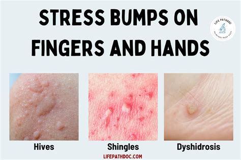 Stress Bumps On Fingers How Do You Get Rid Of Them Vrogue Co Stress Bumps On Fingers How Do You Get Rid Of Them Vrogue Co