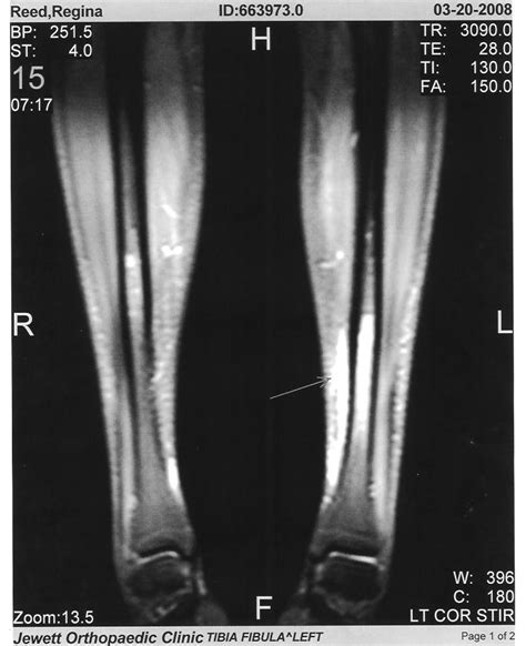 Stress Fracture Shin Mri Xchangebatman