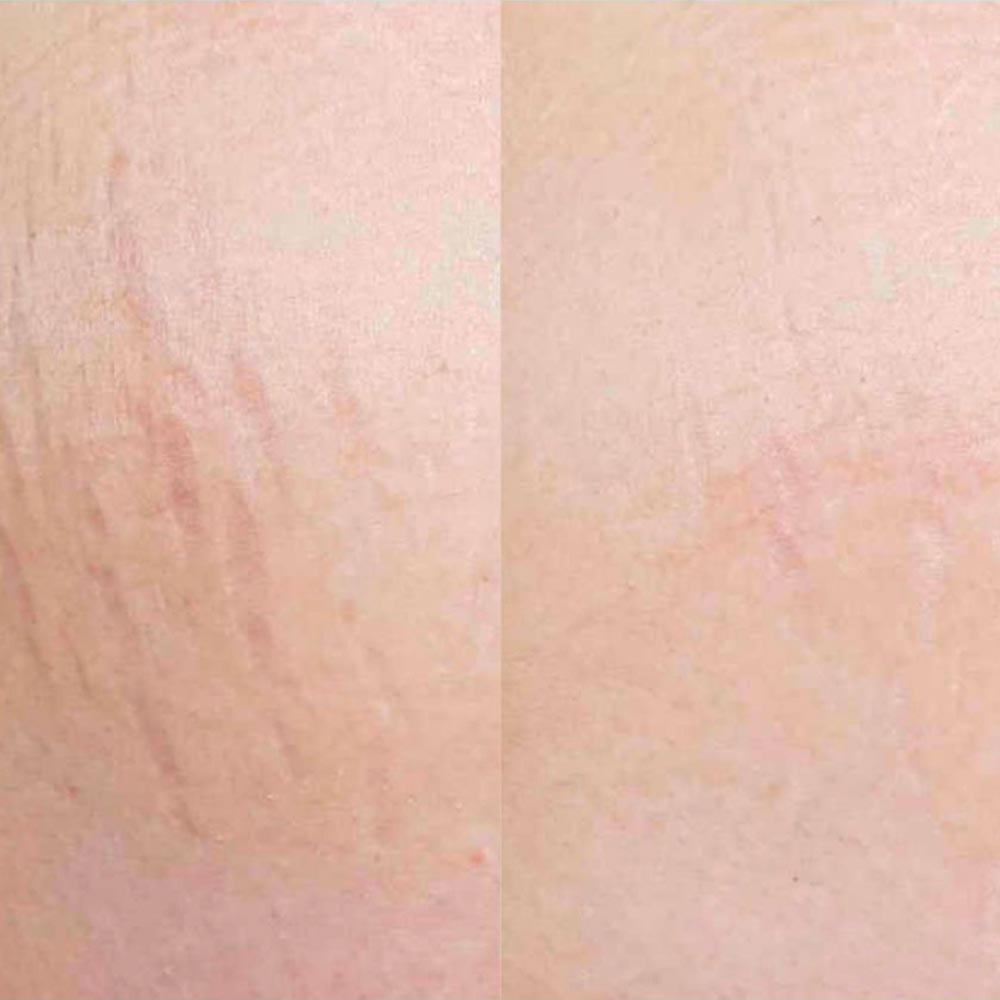 Stretch Marks Removal Miami 305 504 8942 Laser Treatment To Get Rid Stretch Marks Removal Miami 305 504 8942 Laser Treatment To Get Rid