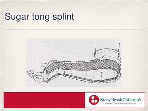 Sugar Tong Posterior Splint At Paul Harlan Blog Sugar Tong Posterior Splint At Paul Harlan Blog