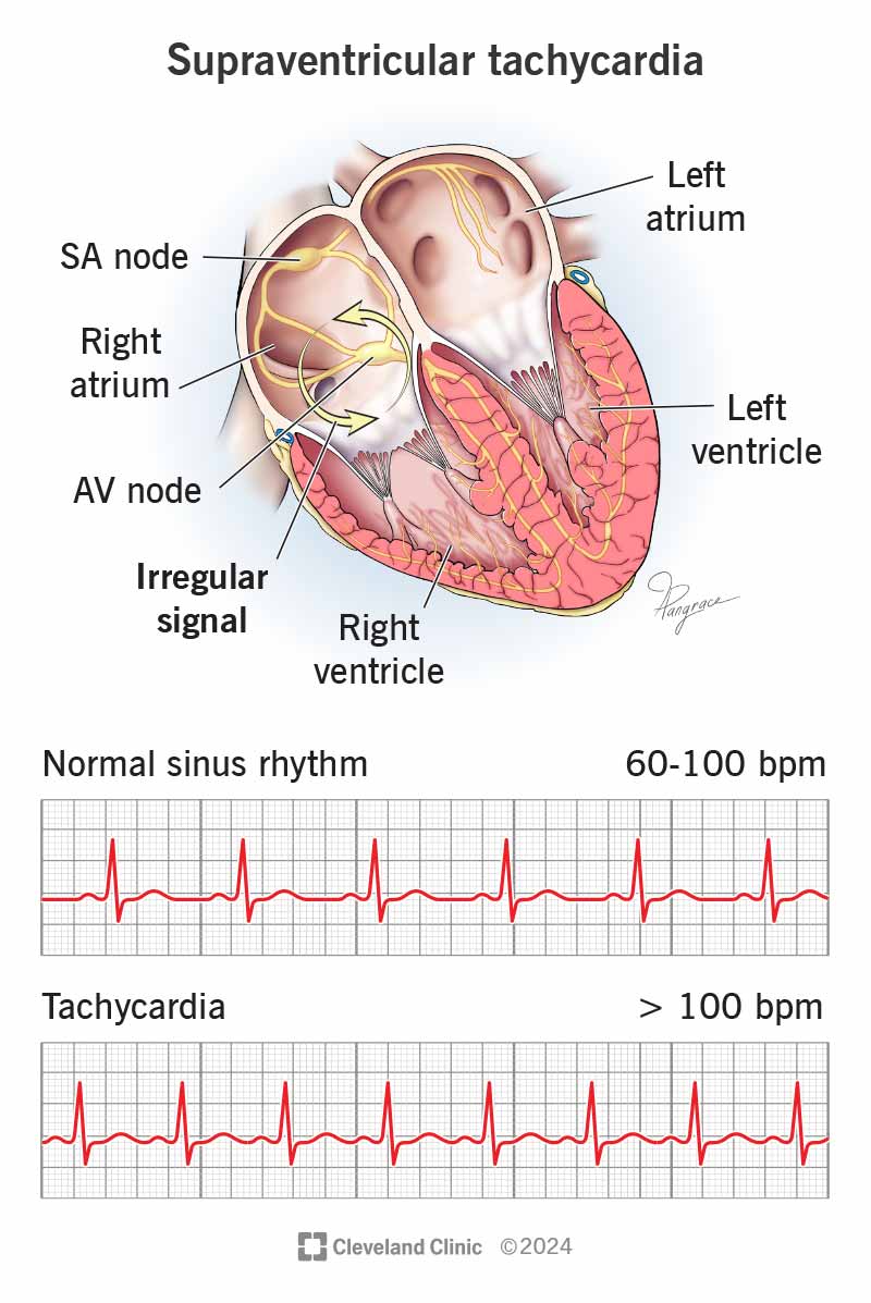 Supraventricular Tachycardia Medical Procedure