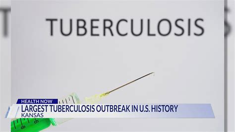 Kansas City TB Outbreak Alert