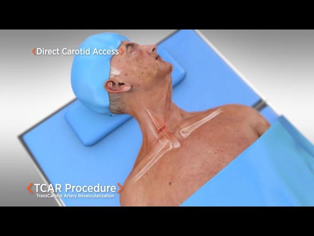 Tcar Test Drive Silk Road Medical Global Website