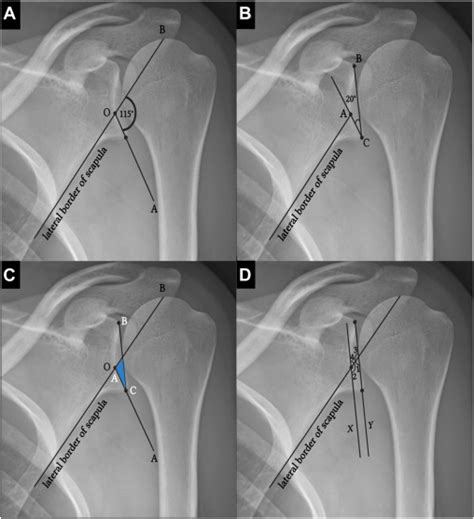 The Base Plate Orientation Angle A Plain Radiographic Technique For The Base Plate Orientation Angle A Plain Radiographic Technique For