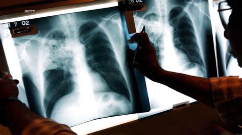 The Tuberculosis Outbreak In Kansas Is Alarming It S Not The Biggest