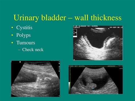 Thickening Of Bladder Wall Slidesharetrick