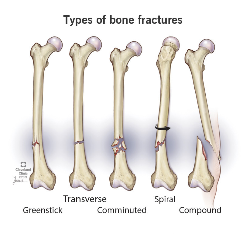 Tibia Fracture Symptoms Causes Treatment Rehabilitation