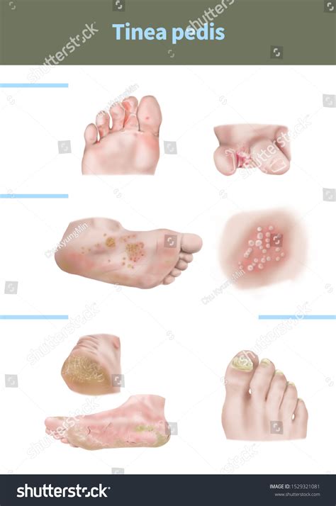 Tinea Pedis Basicmedical Key