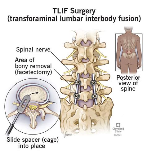 Tlif Medical Abbreviation