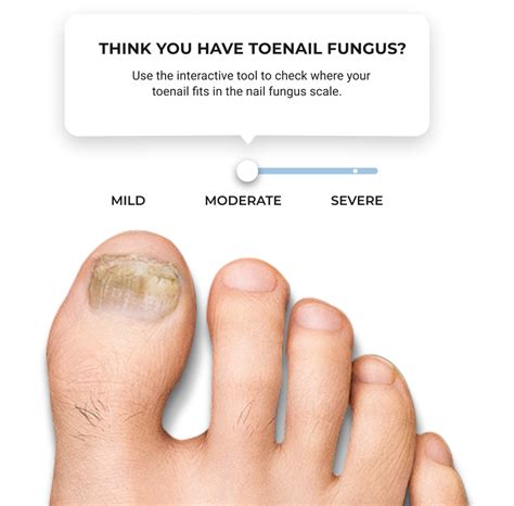Toenail Fungus: Natural Treatment, Symptoms And Causes Axe, 54% Off Toenail Fungus: Natural Treatment, Symptoms And Causes Axe, 54% Off