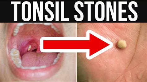 Tonsil Stones Pictures