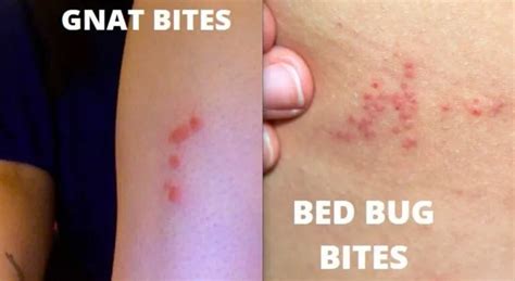 Top 10 Gnat Bites Pictures Explained Pest Professional Services