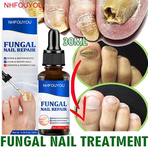 Top Rated Fungal Nail Treatment