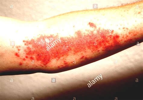 Toxicodendron Radicans Virginia Creeper Rash