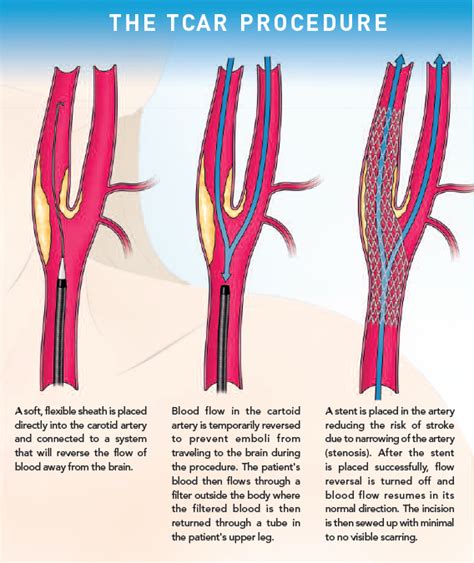 Transcarotid Artery Revascularization St Clair Health