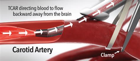Transcarotid Artery Revascularization Tcar Heritage Valley Health