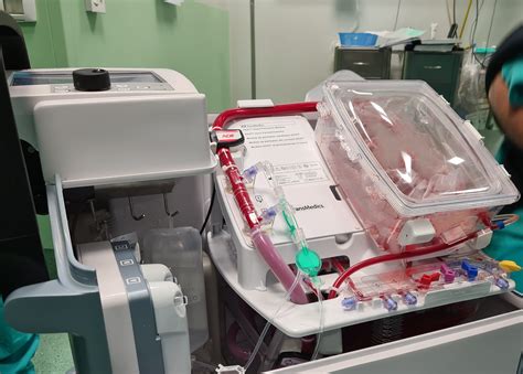 Trapianto Un Sistema Portatile Di Perfusione Cardiaca Tecnica Trapianto Un Sistema Portatile Di Perfusione Cardiaca Tecnica