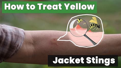 Treatment For A Yellow Jacket Sting Youtube Treatment For A Yellow Jacket Sting Youtube