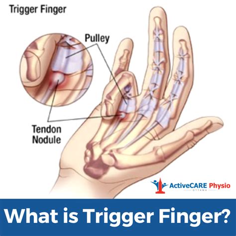 Trigger Finger Medical Devices